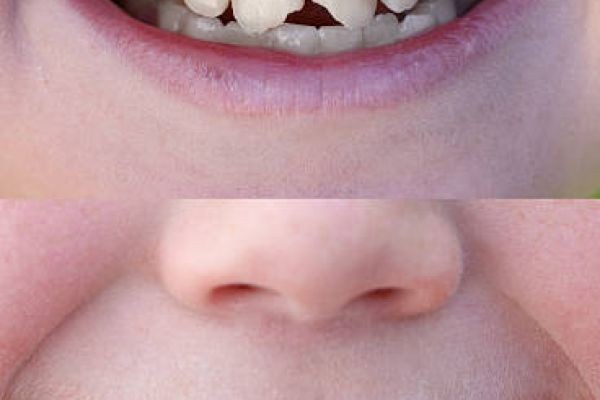 Healthy Smile Restoration: Tooth Fracture Treatment in Islamabad