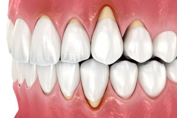 Rebuild Your Gum Health and Smile Gum Grafting in Islamabad: