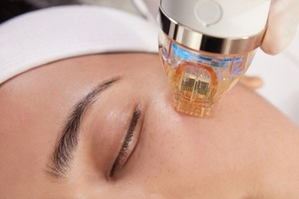 Microneedling Therapy for Clear and Radiant Skin