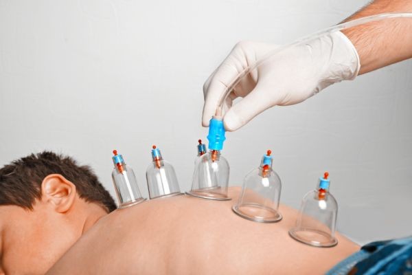 What Influences Hijama Treatment Cost in Dubai Today?