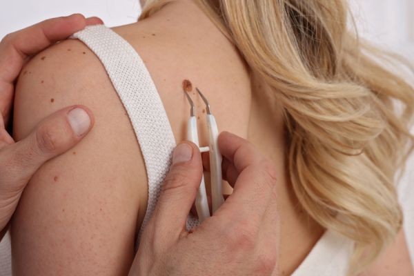 Skin Tag Removal in Islamabad: Modern Treatment Methods