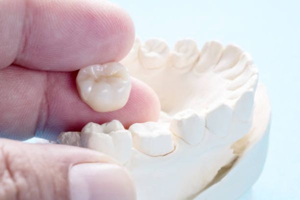 Complete Tooth Protection with Dental crown in Islamabad