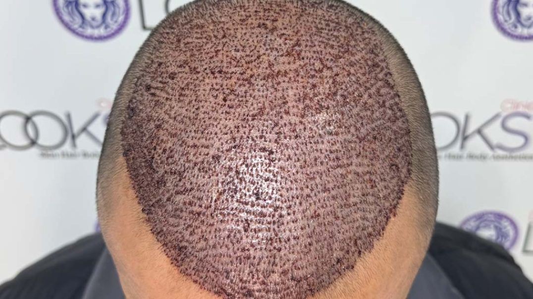 Hair fall bothering you every time you look in the mirror?