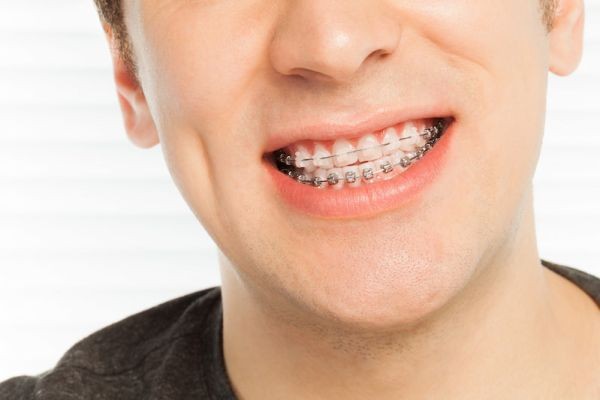 Teeth Braces Cost for Adults Considering Late Orthodontics