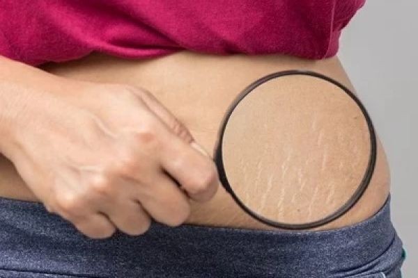 Daily Skin Care Tips to Prevent Stretch Marks in Islamabad
