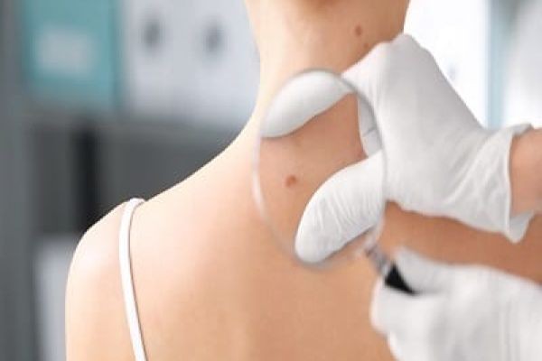 Safe Birthmark Removal Treatments in Dubai