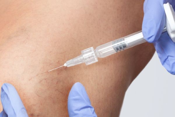 Spider Veins Removal in Islamabad: A Complete Patient Guide