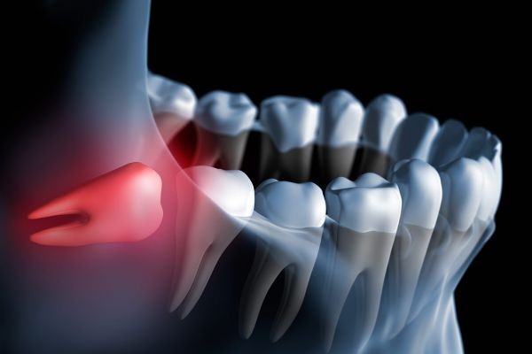 Why Young Adults Need Wisdom Tooth Extraction in Duba