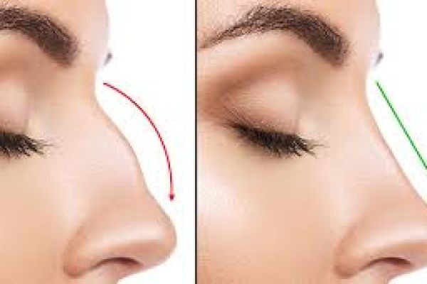 Advanced Rhinoplasty Techniques in Dubai: Your Complete Guide