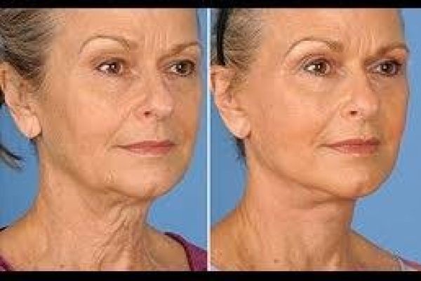 Neck Lift Surgery in Dubai for Wrinkle Reduction and Firm Skin | Youthful Neck Contouring