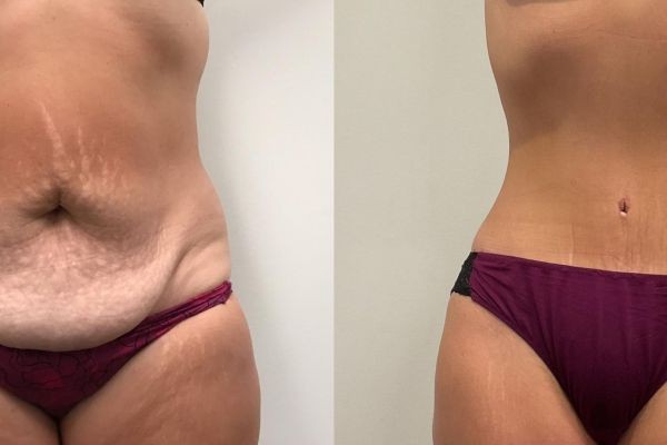 What to Expect After Tummy Tuck Surgery