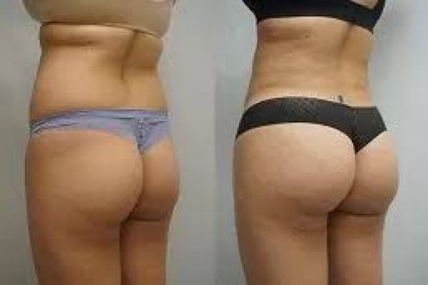 Buttock Contouring in Dubai: Modern Body Sculpting Options for a Balanced Silhouette
