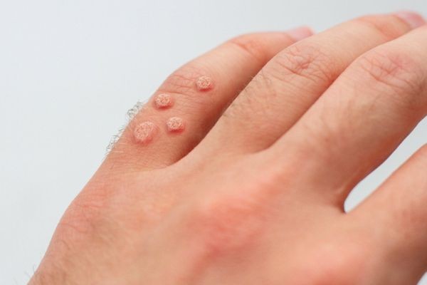 Simple Wart Removal Methods Anyone Can Try