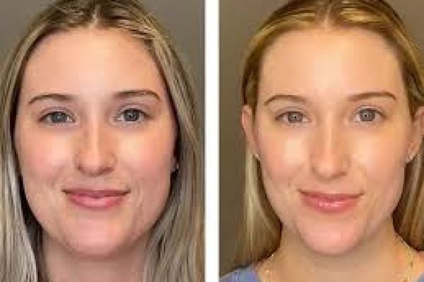 HydraCool Facial for Skin Brightness Enhancement in Dubai | Radiant Glow Treatment Guide