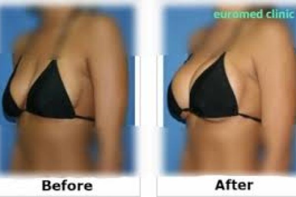 Dubai Breast Reconstruction Surgery Experts: A Comprehensive Guide to Restoring Confidence