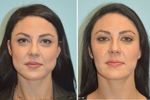 Buccal Fat Removal Post-Surgery Care in Dubai – Expert Tips for Smooth Recovery
