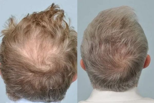 Crown Hair Regrowth Solutions in Islamabad