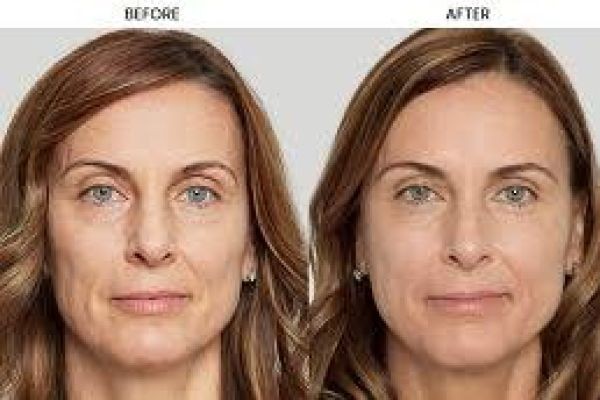 Non-Surgical 8-Point Facelift Procedures in Dubai: A Complete Guide
