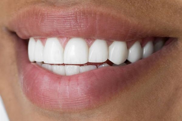 Advanced Tooth Restoration with Dental Fillings in Islamabad