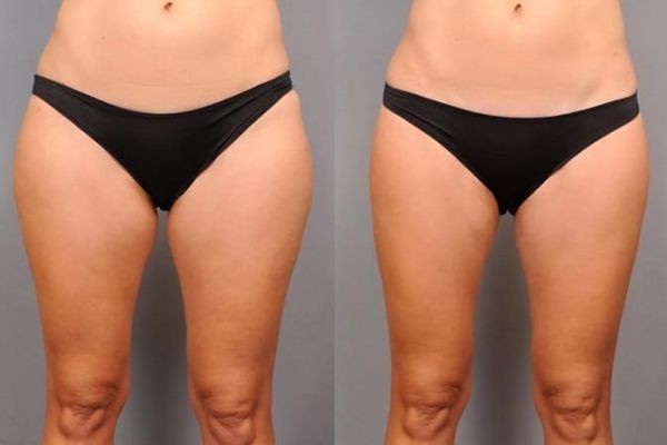 Non-Invasive Thighs and Arms Skin Tightening Dubai – Advanced Body Contouring Solutions