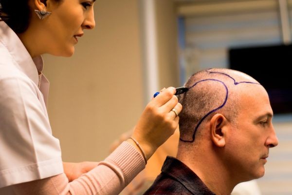 Direct Hair Implant in Islamabad: Myths vs Facts