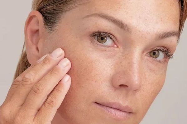 Everything You Need to Know About Melasma in Islamabad