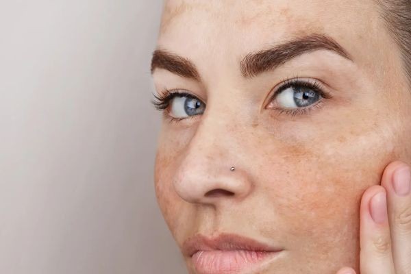 When to Start Pigmentation Treatment in Dubai