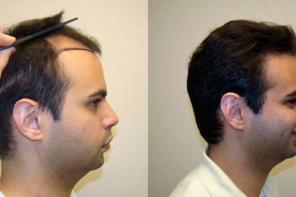 Benefits of Direct Hair Implant in Islamabad