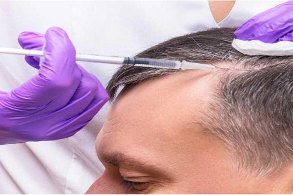 Can Exosome Hair Therapy in Islamabad Stop Hair Fall?