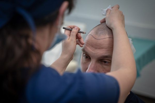 Male vs Female Hair Transplant Cost Differences