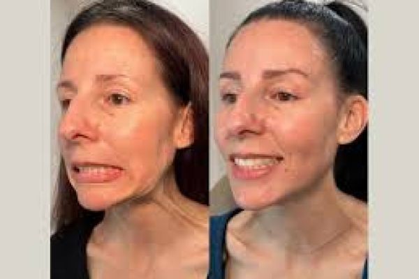Non-Surgical Nefertiti Lift Procedure in Dubai: A Modern Approach to Facial Rejuvenation