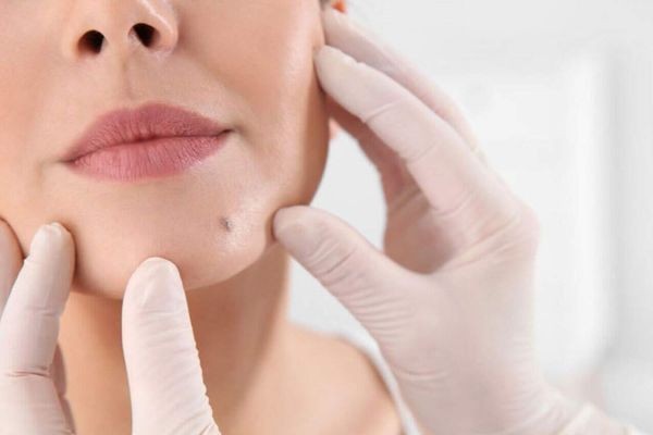 Cost of Mole Removal in Islamabad: Full Breakdown