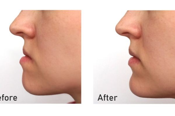 Inspiring Transformations After Jaw Surgery in Islamabad