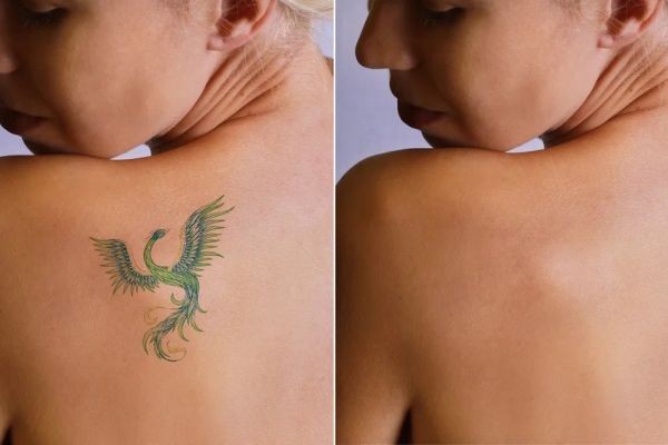 Why Picosure is the Best Laser for Tattoo Removal in Islamabad