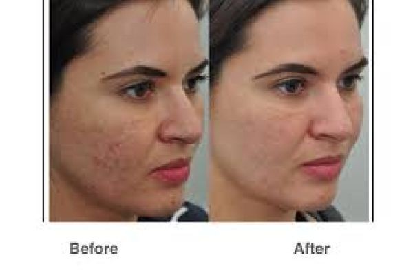 Innovative Fractional CO2 Laser Procedures in Dubai for Advanced Skin Rejuvenation