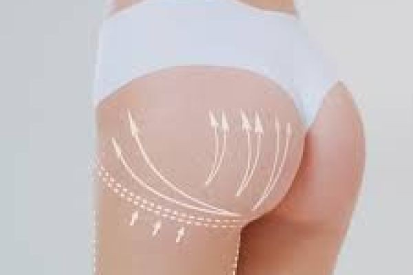 Buttock Augmentation in Dubai: Aesthetic Transformation Guide for Natural Results