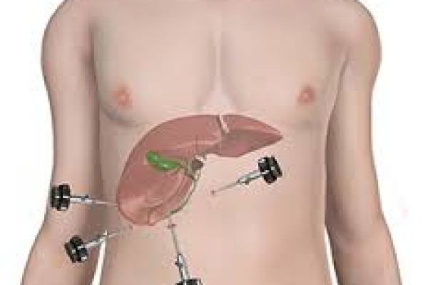 Biliary Duct Reconstruction Surgery in Dubai: Everything You Need to Know