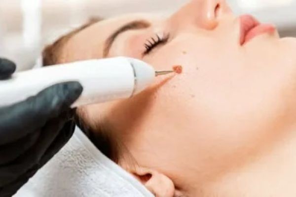 Safe Home Treatments for Warts in Islamabad