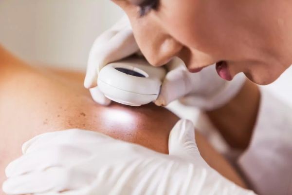 When Is the Best Time for Mole Removal in Dubai