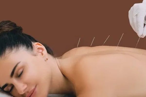 Find Long-Term Relief with Acupuncture in Islamabad