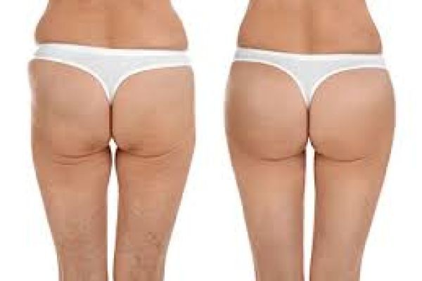 Reliable Buttock Lift Options and Aesthetic Enhancement in Dubai