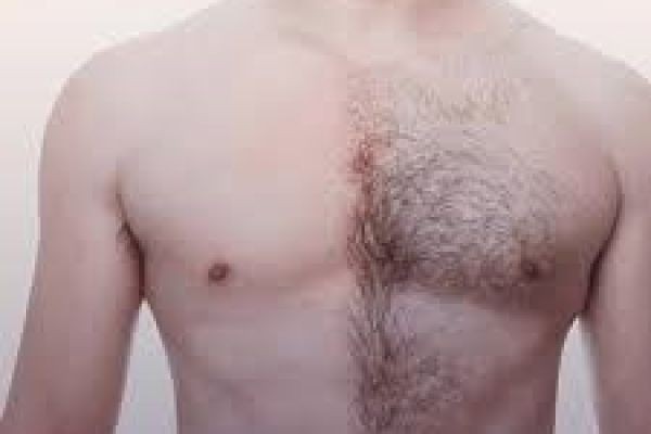 Latest Techniques Used in Body Hair Transplant in Islamabad