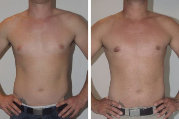 Dubai Gynecomastia Surgery Recovery Tips – Complete Healing Guide for Smooth Results