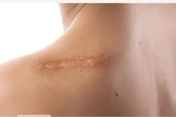 Top Ways to Treat Surgical Scars in Islamabad