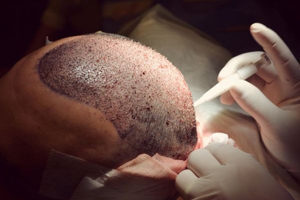 Beginner’s Guide to Hair Transplant in Islamabad