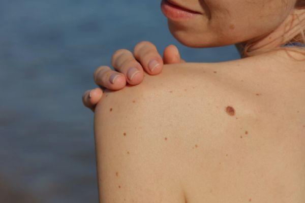 What to Know Before Mole Removal in Dubai