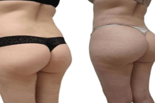 Best Clinics for Buttock Augmentation in Dubai