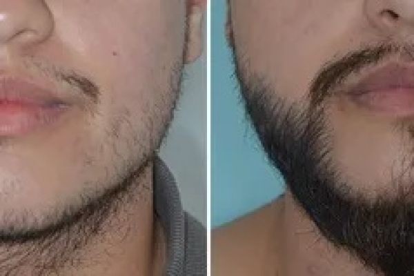 Perfect Beard Shape with Hair Transplant in Islamabad