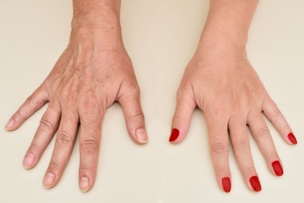 Rejuvenate Hands with Precision, Care, and Expertise