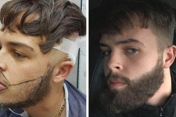 Moustache Hair Restoration in Islamabad: A Complete Breakdown